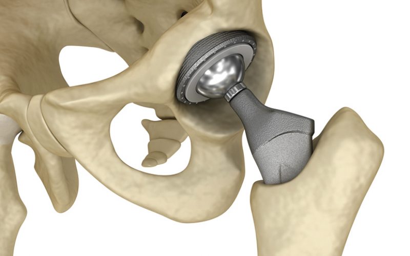 Как выглядит искусственный тазобедренный сустав фото