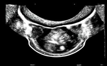 Как проводится ультразвуковое исследование в гинекологии и какие инструменты используются