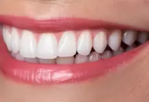 Что влияет на стоимость виниров?