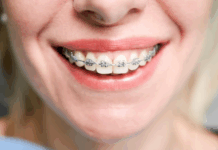 Вестибулярные брекеты: путь к идеальной улыбке