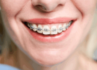 Вестибулярные брекеты: путь к идеальной улыбке