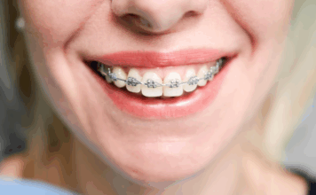 Вестибулярные брекеты: путь к идеальной улыбке